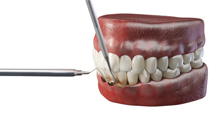 3d rendered illustration of dental root planning