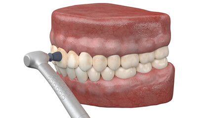 3d rendered illustration of teeth polishing