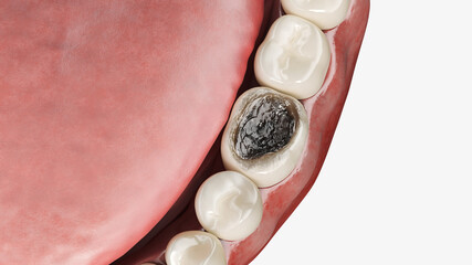 3d rendered illustration of tooth decay