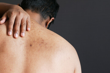 close up of young man suffering skin problem .