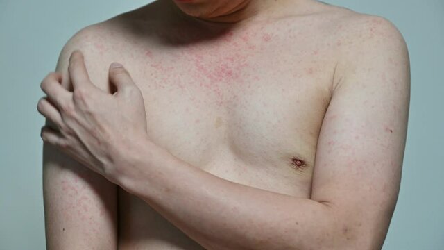 Dermatitis viral disease of young adult asian body standing scratching with itching, Red Rash, Measles Virus, Viral Exanthem