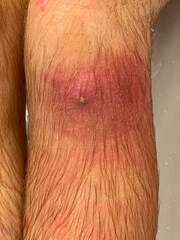 VERTICAL Small cut on man's knee gets infected and filled with yellow puss.