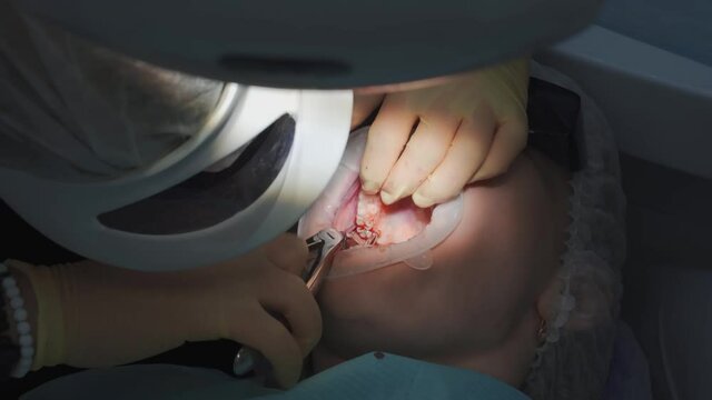 real. dentist pulls out a sick wisdom tooth. 