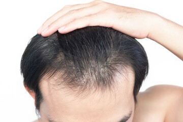 Fototapeta premium Closeup Young man serious hair loss problem with white backgroun for health care medical and shampoo product concept, selective focus