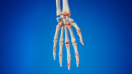 Obraz na płótnie Canvas 3d rendered illustration of an arthritic hand