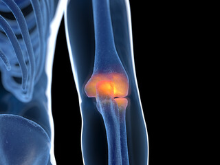 3d rendered illustration of an inflamed elbow joint