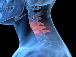 3d rendered illustration of an inflamed neck - obrazy, fototapety, plakaty