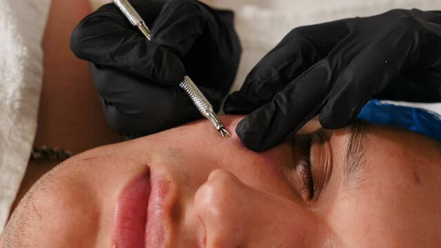 Cosmetology beauty clinic. Male patient getting facial treatment. Acne cleaning procedure with medical spoke tool. Beautician making face skin cleaning of man. Inflammation men treatment. 4 k video