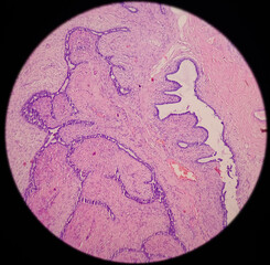 Breast Biopsy: Microscopic image of a fibroadenoma, show benign neoplasm composed of delicate proliferation of fibro muscular and glandular tissue on a myxoid background, benign tumor.