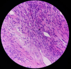 Fibroid uterus leiomyoma, myoma, also known as fibroids, benign tumor of the uterus, photo under microscope, no malignancy seen