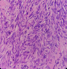 Fibroid uterus leiomyoma, myoma, also known as fibroids, benign tumor of the uterus, photo under microscope, no malignancy seen