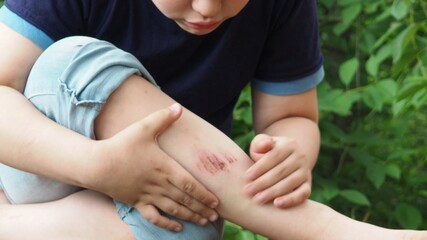 Closeup of injured young kid's knee after he fell down on pavement. the boy's leg hurts. bruise, scratch after summer walks or sports. anesthetic ointment - obrazy, fototapety, plakaty