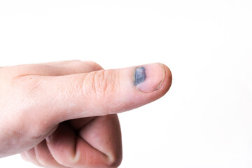 Bruise under the nail on the thumb
