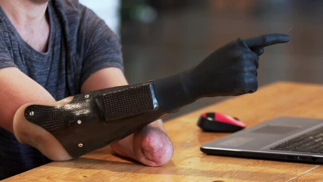 Close view of a modern bionic hand. A man living with a disability with amputated two stump hands is trying to control his new prothesis and moving fingers with smile. A laptop is in front of him