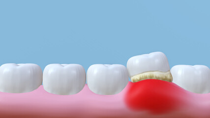 3d rendering of teeth in bleeding gums becuase of tartar and bactrail tooth plaque
