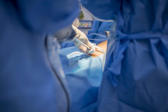 A close up of hands of surgeons team during operation gall bladder stone removal with surgical laparoscopy instruments. Key hold surgery in cholecystitis with abdominal pain. 