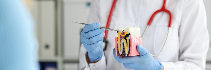 Dentist shows on dental model how caries destroys tooth enamel
