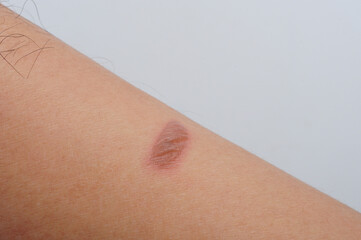 Naklejka premium Blister was caused by a burn or scald, sunburn, or an allergic reaction