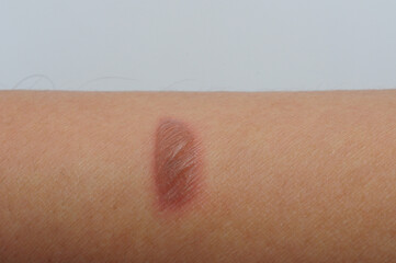 Naklejka premium Blister was caused by a burn or scald, sunburn, or an allergic reaction