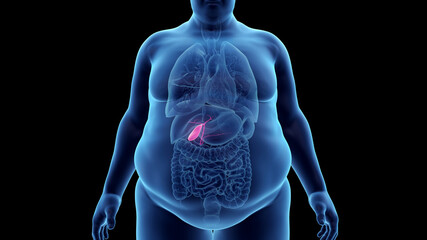 3d rendered illustration of an obese mans gallbladder