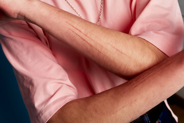 The skin condition after cat scratch and bite of veterinary surgeon hand during physical examination in a veterinary clinic.