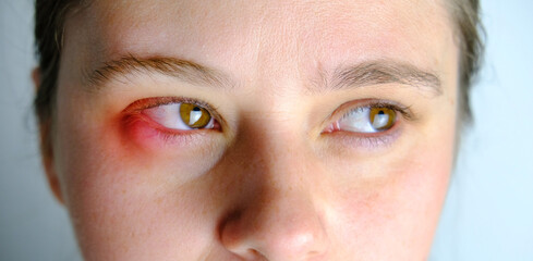 heals sore, sickly eye of female patient, closeup part of the face young woman, concept examination...