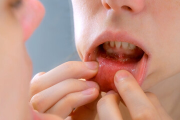 Stomatitis in woman's mouth after dental treatment, disease in the mouth. Stomatitis on the lower...