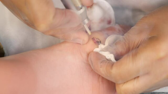 Surgeon removing wart on teen boy's foot using laser in hospital, hands in gloves closeup. Remove papillomavirus verruca on leg. One day surgery concept. Sore and wound after operation.