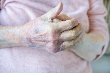 wrinkled hands with very dry skin and deep cracks because of eczema. - obrazy, fototapety, plakaty