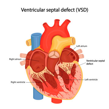 Ventricular septal defect (VSD). Congenital heart defect. cartoon anatomical illustration