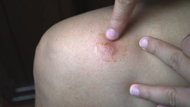 Footage b roll of Man with leg abscess Massage to relieve pain by applying balm. dermatitis. Pain. abscess disease