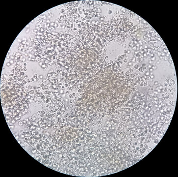 Microscopic image show plenty Pus cells. Urinary tract infection. Pyuria.