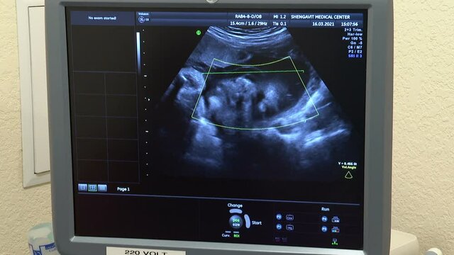 Yerevan, Armenia - October, 2021, Sonography. The screen of the ultrasound machine. Results of the ultrasound on the monitor. Health care concept.