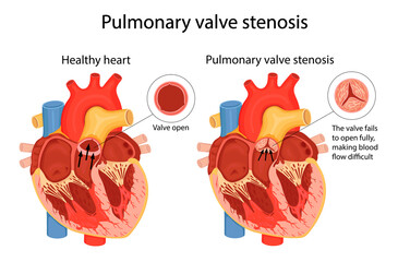 pulmonary valve stenosis. anatomical illustration - obrazy, fototapety, plakaty