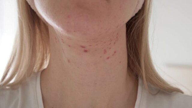 Woman with inflamed cystic acne on her neck and jawline area, close up.