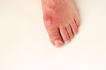 Swollen leg of a man with painful inflammation of gout. Fungus of the nail. There is free space for...