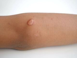 A scar on a  kid boy arm. closeup photo, blurred.