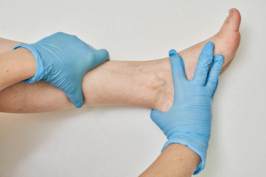 Doctor Examining Varicose And Spider Veins On The Woman's Leg And Feet