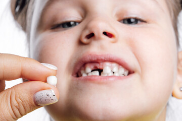 Two fingers holding torn out milk tooth in front of little girl face looking down at camera, showing teeth behind on white background. First teeth changing. Going to dentist to do tooth treatment. 