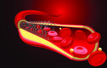Medical and educational illustrations of the stent are already inserted, improving blood flow.