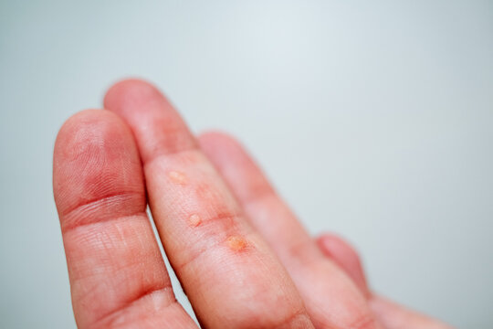 Wart on the finger of the hand. Papilloma on the arm. Skin disease. Rash of growths on the upper cover of the skin.