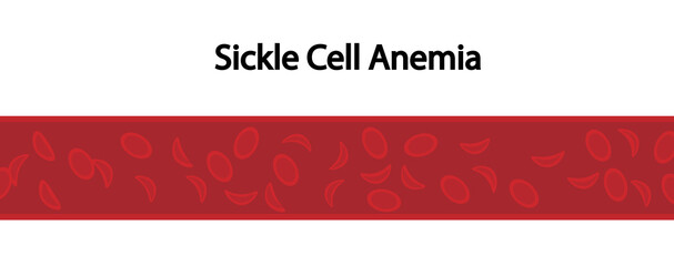 Sickle Cell anemia illustration. Hemoglobin sickle cell in blood vessel.