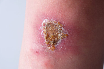 Close-up of an infected wound on  knee of  womans leg - obrazy, fototapety, plakaty
