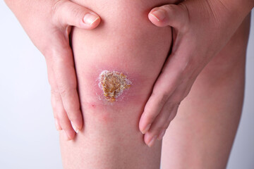 Infected wound on the knee close up, healing process