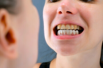 Woman is looking at mirror on her different teeth lower white with veneers and upper yellow. The gradual process of installing veneers and crowns on all teeth. Cosmetic dentistry, orthodontics.