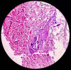 Chest wall cyst(biopsy): Epidermal inclusion cyst, commonly called 