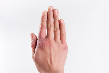 Obraz premium close up of female hand with chilblain on white background