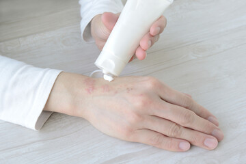 手荒れ・あかぎれの手にクリームを塗る女性の手元