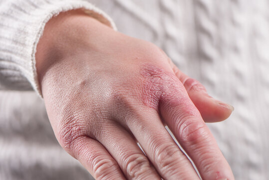 close up of female hand with chilblain on white background