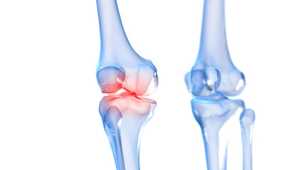 3d rendered illustration of a painful knee